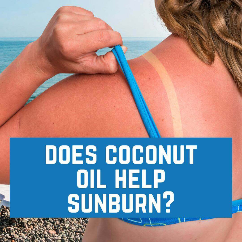 Does Coconut Oil Help Sunburn?