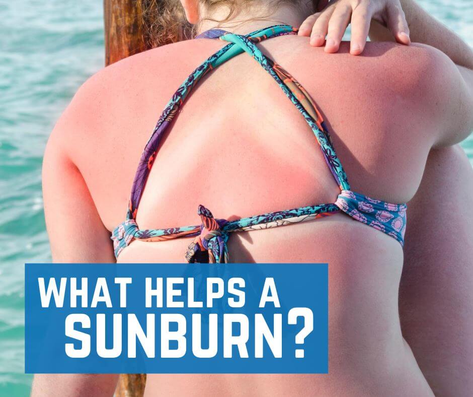 What helps sunburn?