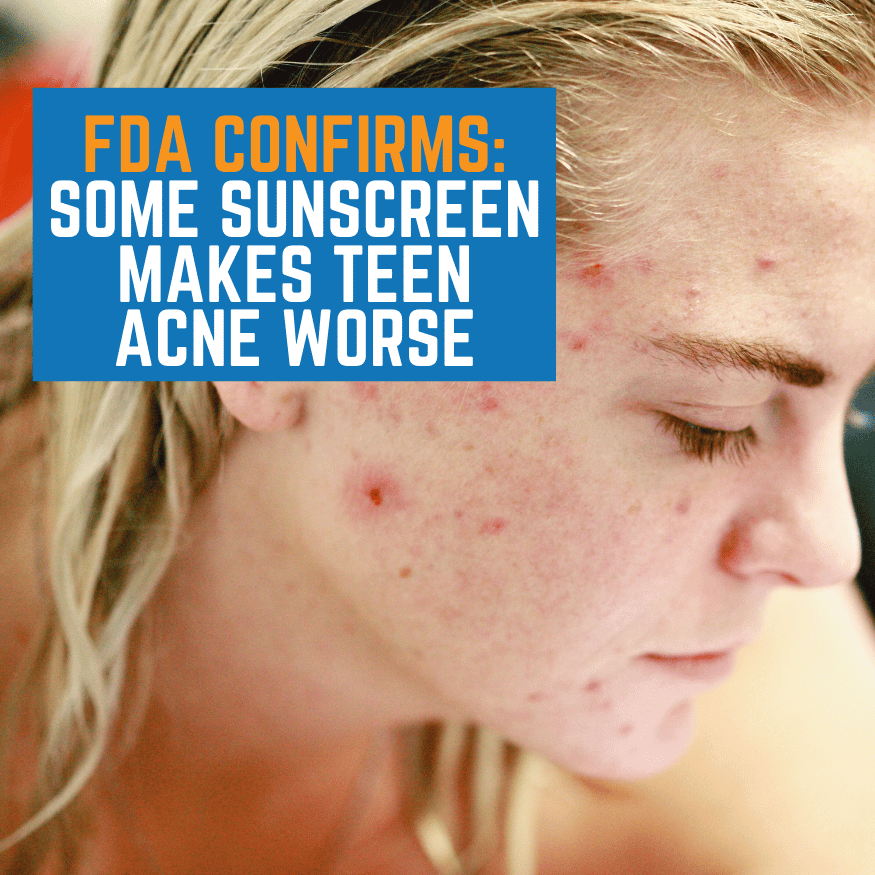 Mineral vs Chemical Sunscreen for Acne-Prone Skin